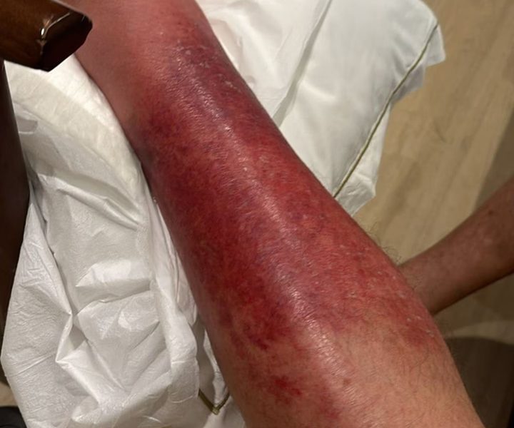 Ex-presidente Bolsonaro relata melhoras em seu quadro de saúde após infecção na perna esquerda e desconforto intestinal Ex-presidente Bolsonaro relata melhoras em seu quadro de saúde após infecção na perna esquerda e desconforto intestinal